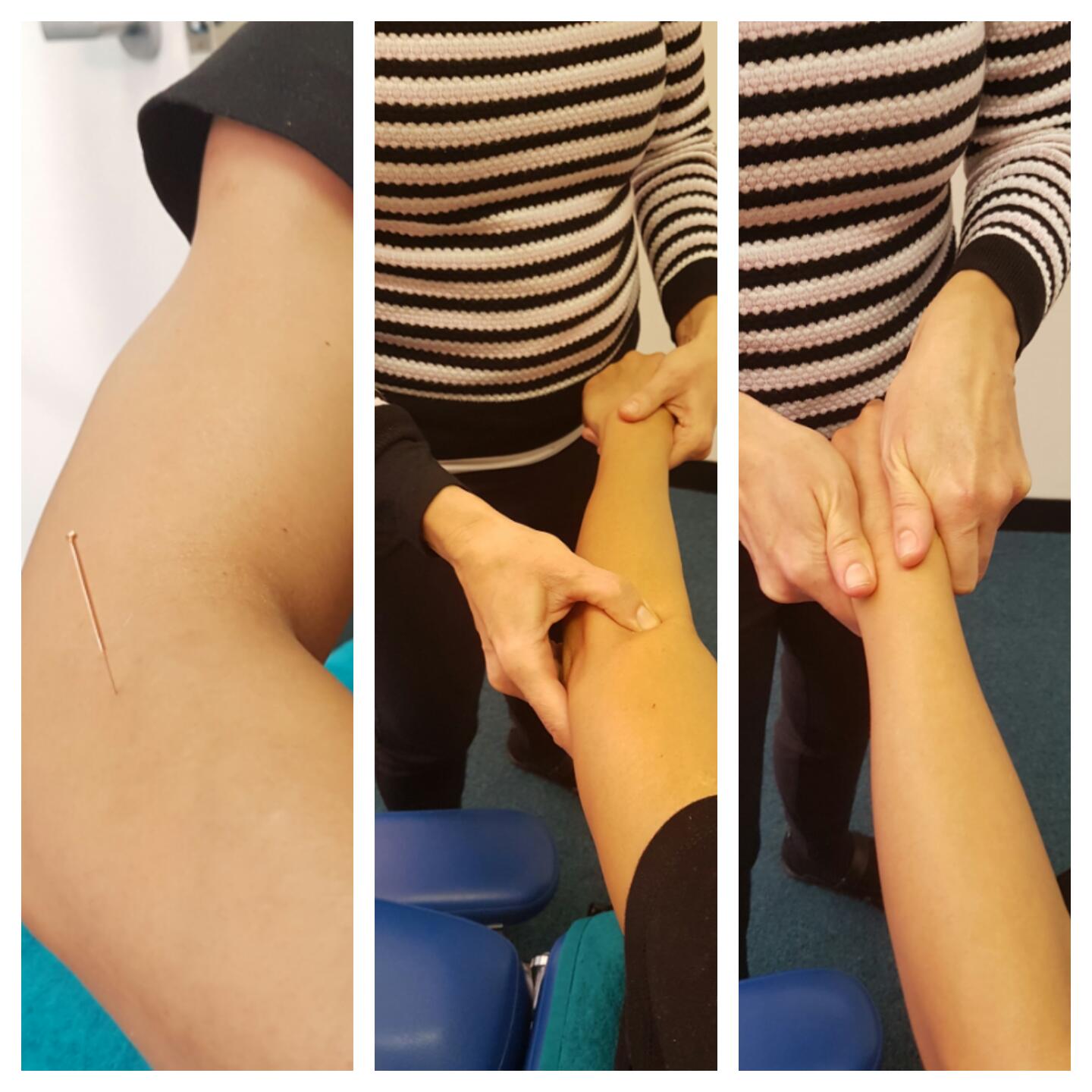 Ulnar Nerve Decompression at the Elbow Westmead, NSW