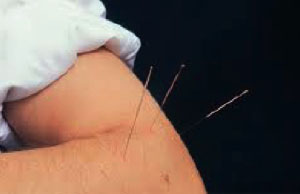 dry needling Joondalup, Perth  6027 lakeside chiropractic