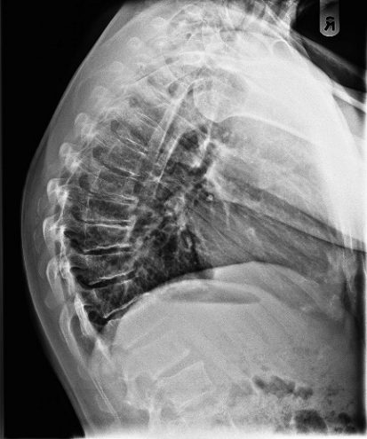 causes of Scheuermann’s disease