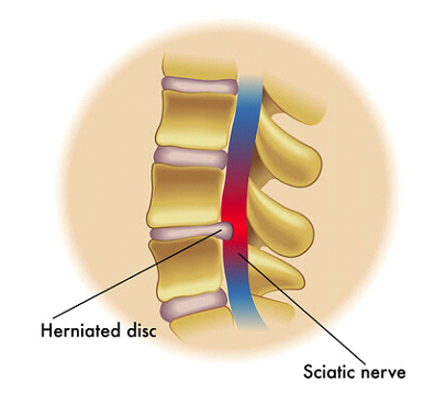 herniated disc